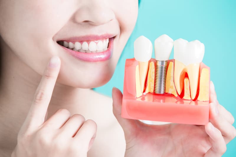 Trồng Implant mang đến nhiều lợi ích cho người làm.