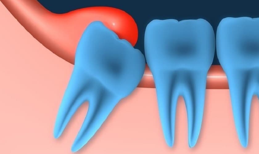 Biểu hiện viêm lợi trong cùng