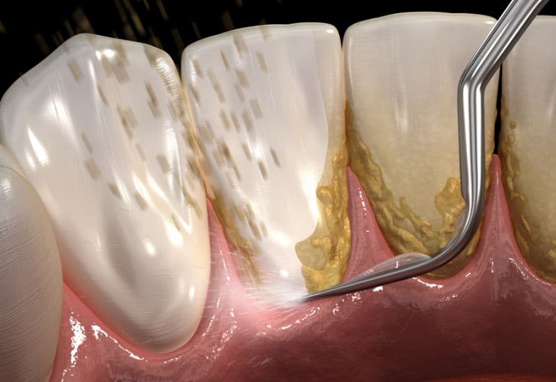 Nha sĩ sử dụng dụng cụ lấy vôi răng phát ra sóng siêu âm giúp phá vỡ vôi răng một cách nhẹ nhàng mà không làm hại đến răng.