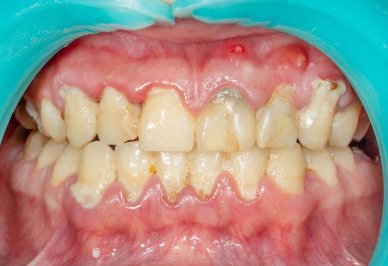 Mảng bám là tập hợp vi khuẩn, thức ăn thừa, protein trong nước bọt và các tế bào chết.