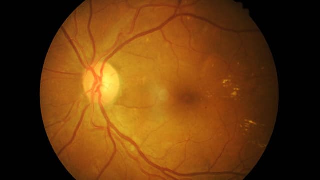 Võng mạc nhân tạo và những điều bạn cần biết