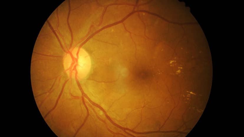 Võng mạc nhân tạo và những điều bạn cần biết