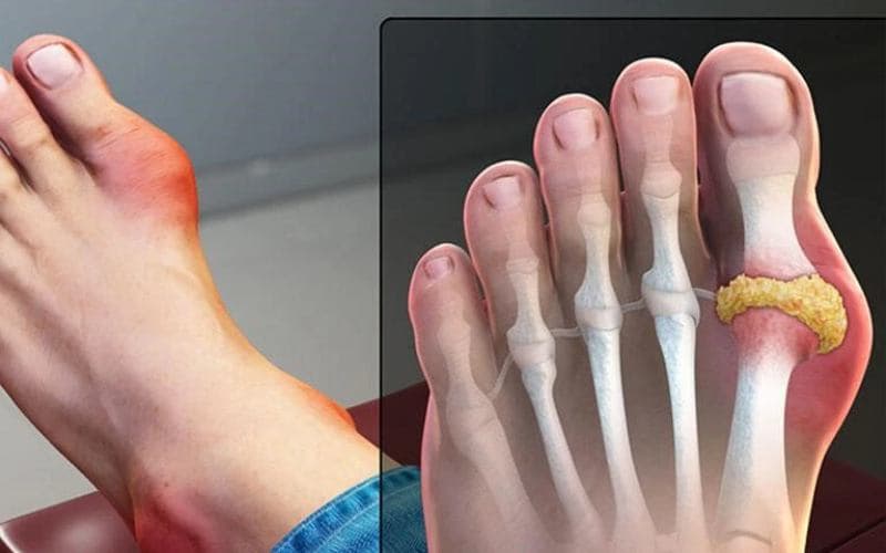 Febuxostat và bệnh gout