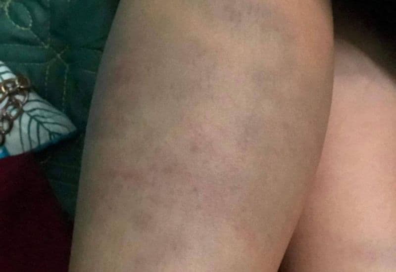 biểu hiện chấn thương phần mềm ở bắp chân