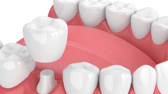 Giải đáp: bọc răng sứ giá bao nhiêu 1 chiếc