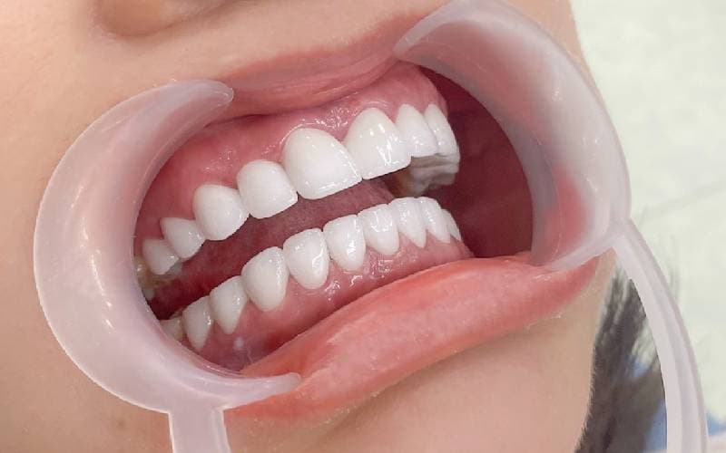 bọc răng sứ hai hàm giá bao nhiêu hả bác sĩ