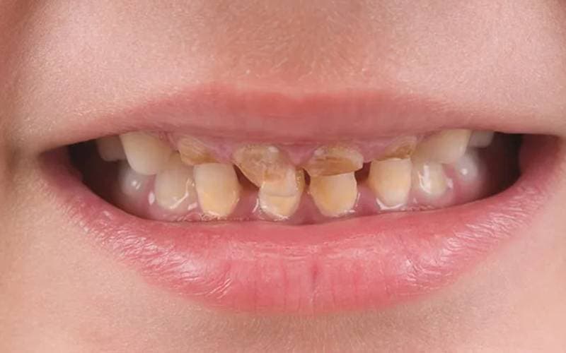 hỏi bọc răng sứ hai hàm giá sẽ bao nhiêu