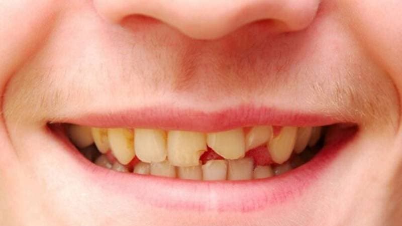 bọc răng sứ hết bao nhiêu tiền tại bệnh viện