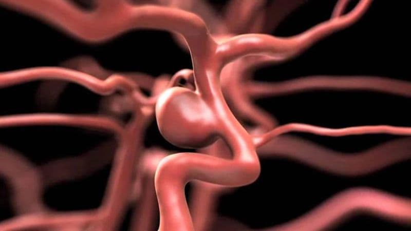 Các loại phình mạch não thường gặp