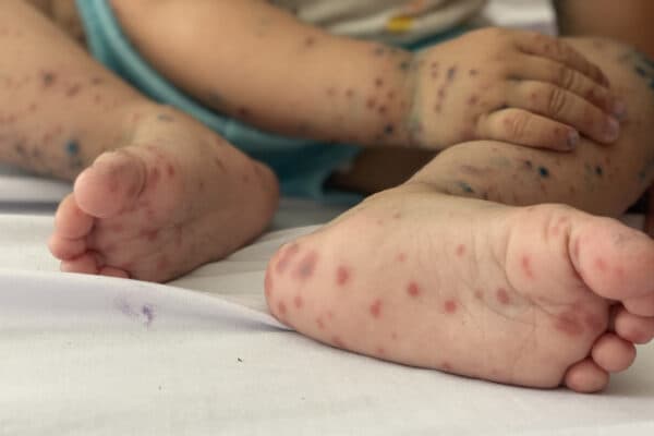 Cần để ý vệ sinh cá nhân cho trẻ khi mắc tay chân miệng.