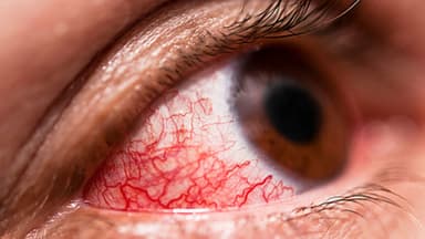 Hướng dẫn cách chữa đau mắt đỏ hiệu quả mùa mưa lũ