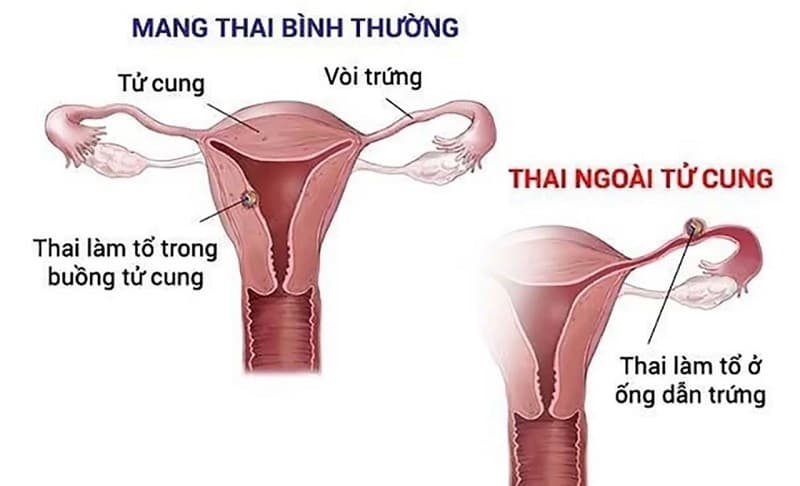 Hình ảnh minh họa vị trí thai ngoài tử cung và thai trong buồng tử cung