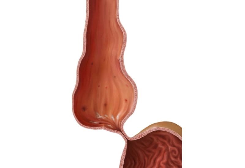 Các bệnh lý được chẩn đoán qua HRM từ triệu chứng đau họng khó nuốt nước bọt