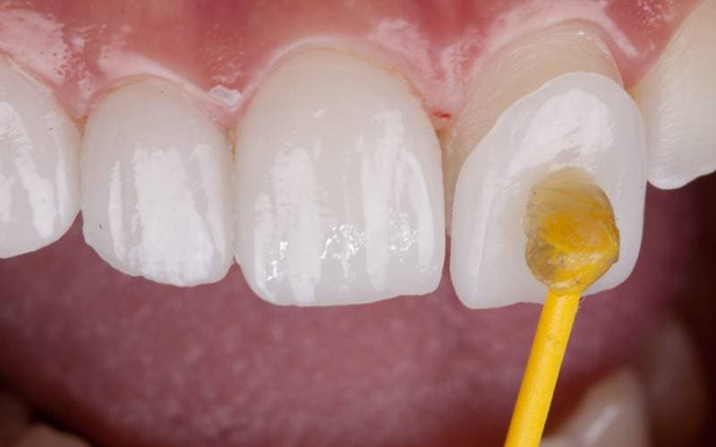 dán răng sứ veneer bao nhiêu tiền tại TCI