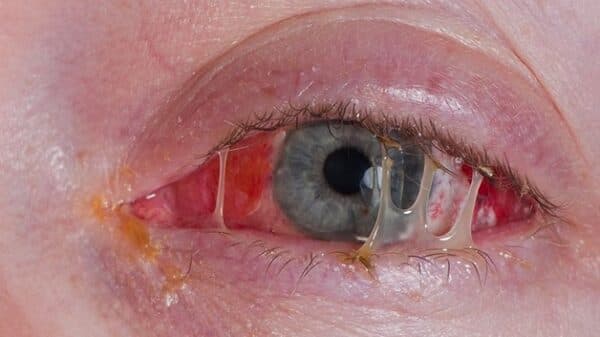 Đau mắt đỏ ra nhiều ghèn có thể làm ảnh hưởng đến chất lượng cuộc sống.