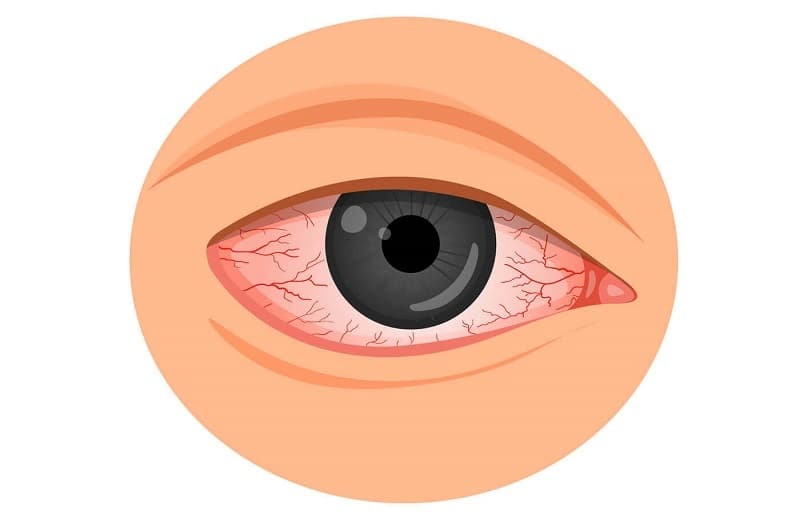 Vì sao dịch đau mắt đỏ dễ bùng phát vào mùa nước lũ