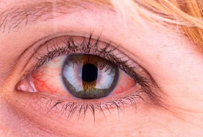 Điều kiện sinh hoạt thiếu thốn có thể khiến bạn suy giảm hệ miễn dịch, dễ mắc bệnh về mắt