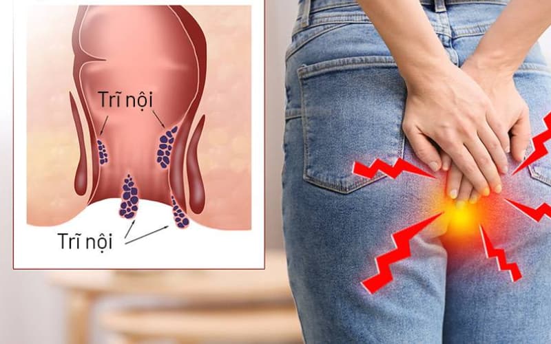 Diosmin 600mg chữa trĩ