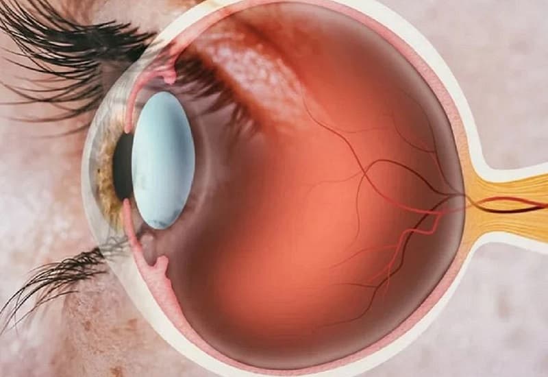 Tuổi tác là nguyên nhân hàng đầu khiến thể tinh thủy hình thành vùng đục