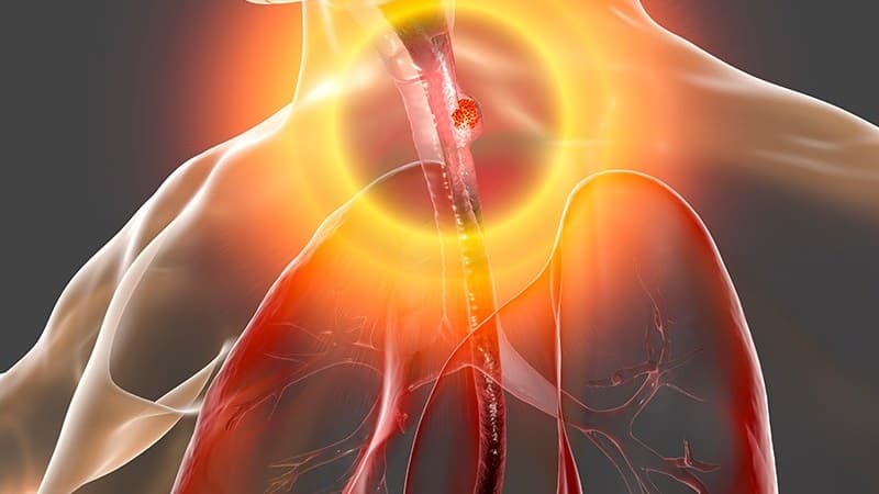 Khối u thực quản có thể điều trị bằng nhiều cách