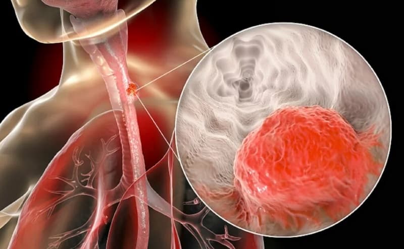 Khó thở nuốt nghẹn là triệu chứng ung thư thực quản điển hình