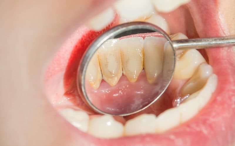 có nên lấy cao răng công nghệ mới ko