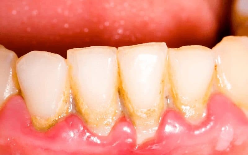 Lấy cao răng tự nhiên như thế nào