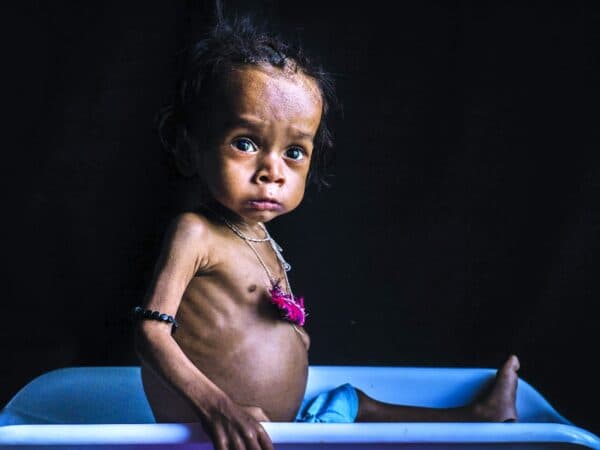 Ở nhiều nước có điều kiện kinh tế kém cũng có nhiều trẻ em bị suy dinh dưỡng.