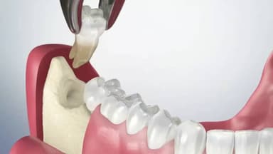 Tìm địa chỉ nhổ răng khôn Hà Nội