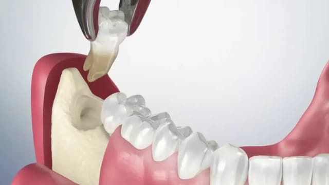 Tìm địa chỉ nhổ răng khôn Hà Nội