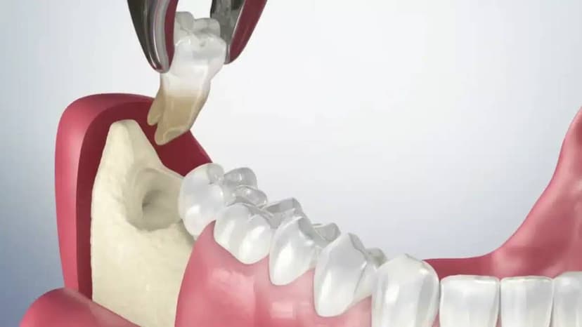 Tìm địa chỉ nhổ răng khôn Hà Nội