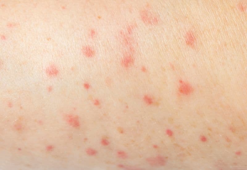 Quá trình nốt thủy đậu mưng mủ diễn ra như thế nào?