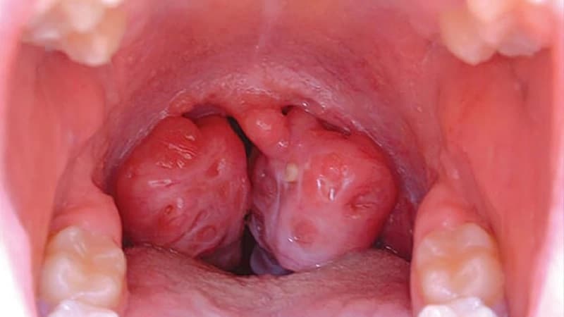 Hình ảnh khối u cản trở nuốt