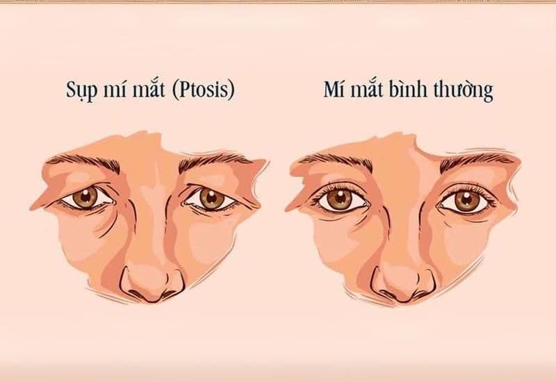 Tùy nguyên nhân sụp mí là gì mà phương án phẫu thuật sẽ khác nhau.
