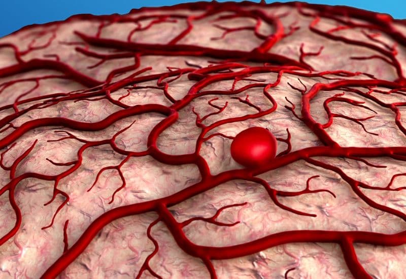 Phình mạch não và vỡ túi phình mạch não có nguy hiểm không?