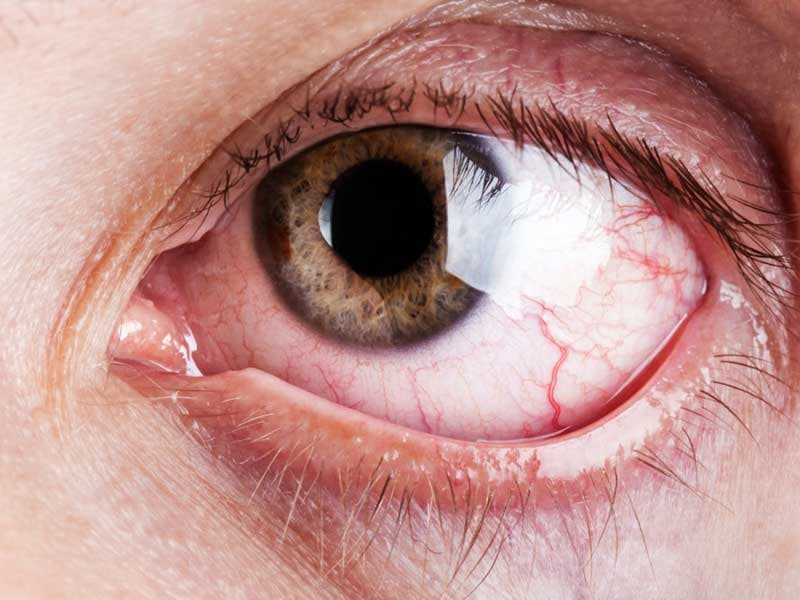 Phù võng mạc là tình trạng tích tụ chất lỏng bất thường trong các mô của võng mạc.