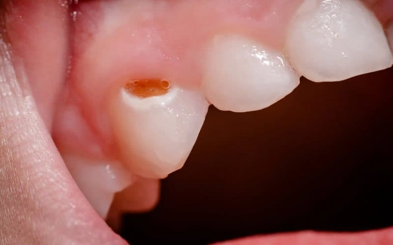 sạch cao răng đúng cách