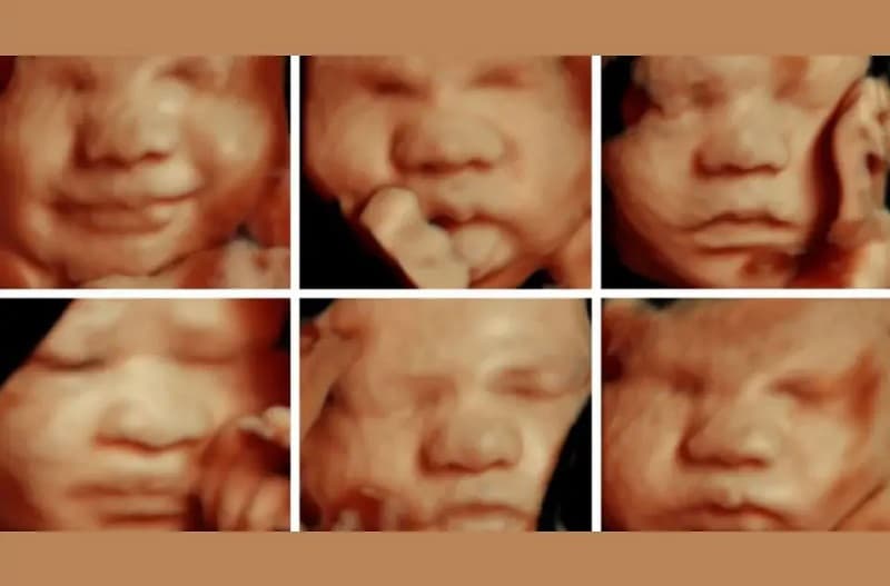 Hình ảnh siêu âm 3D