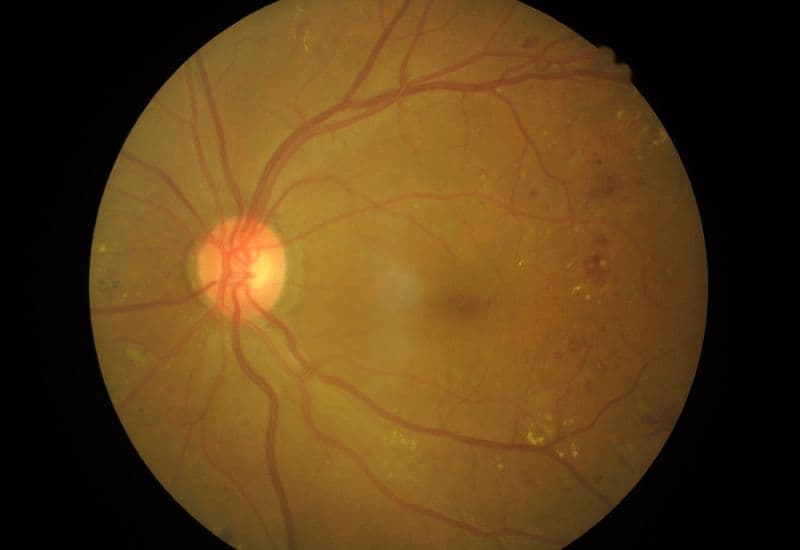 Tân mạch võng mạc là hiện tượng các mạch máu mới, bất thường hình thành trên bề mặt hoặc bên trong võng mạc.