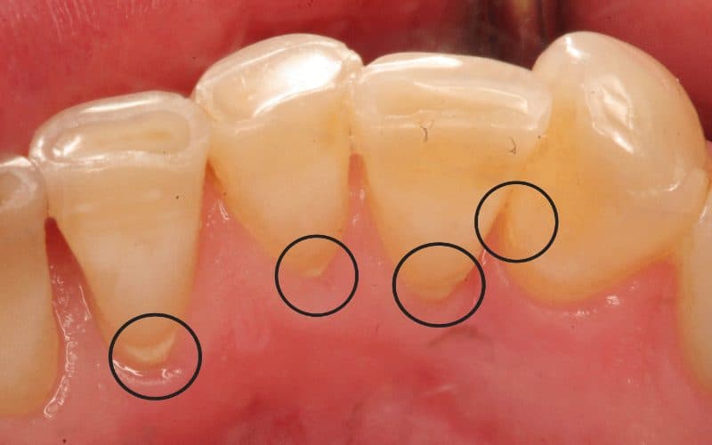 tẩy vôi răng tại nhà an toàn