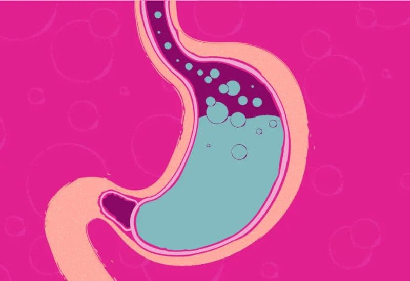 Cơ chế hình thành ợ hơi trong bệnh trào ngược dạ dày