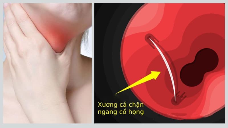 Trị hóc xương cá nhỏ sai cách