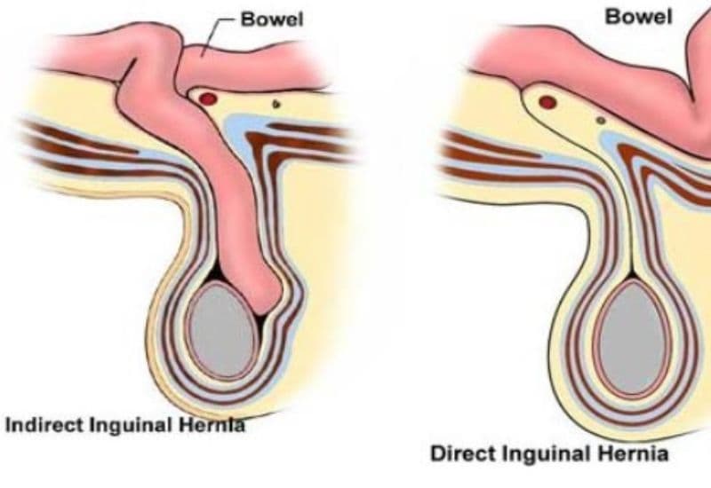 nguyên nhân và triệu chứng thoát vị bẹn