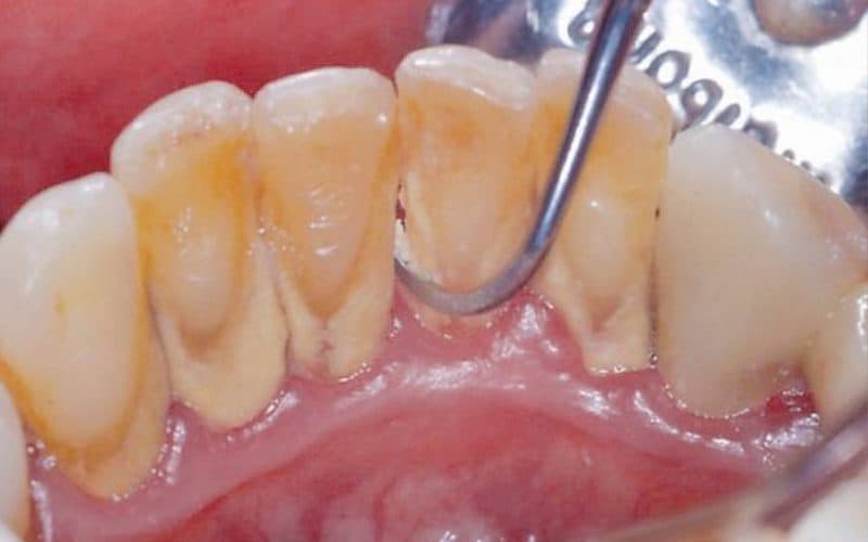 Tự làm sạch cao răng tại nhà ra sao