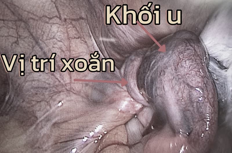 Hình ảnh một khối u nang bị xoắn