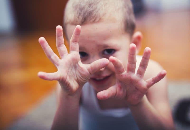 Phát ban ở tay, chân, miệng là triệu chứng điển hình của tay chân miệng.