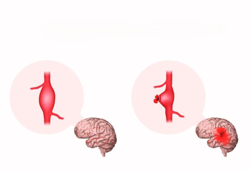 Vỡ túi phình mạch não có gây tử vong không?