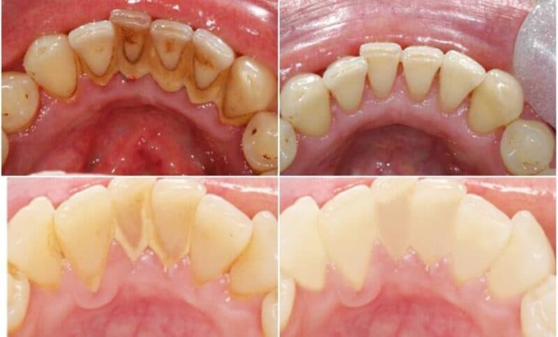 có nên cạo vôi và tẩy trắng răng