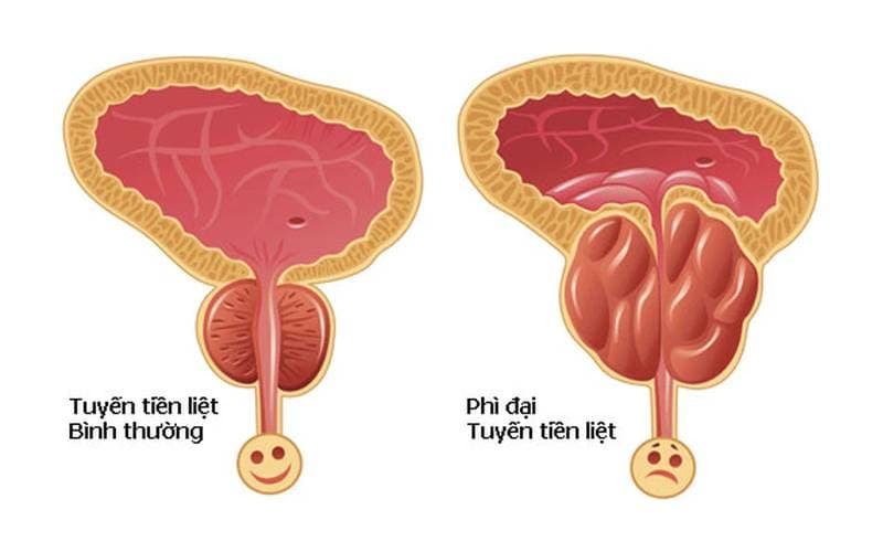 Avodart và tuyến tiền liệt