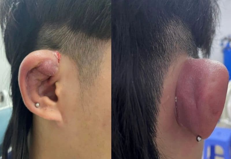 áp xe tai biến chứng lan rộng